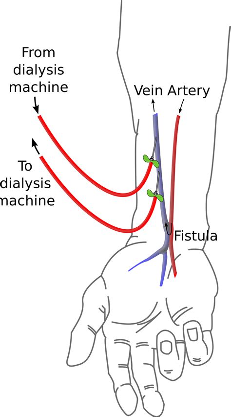 AV Fistula | Time of Care