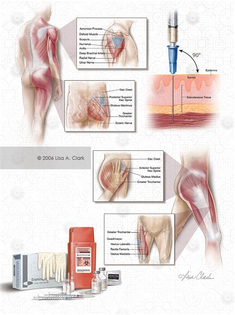 Three Intramuscular Injection Sites