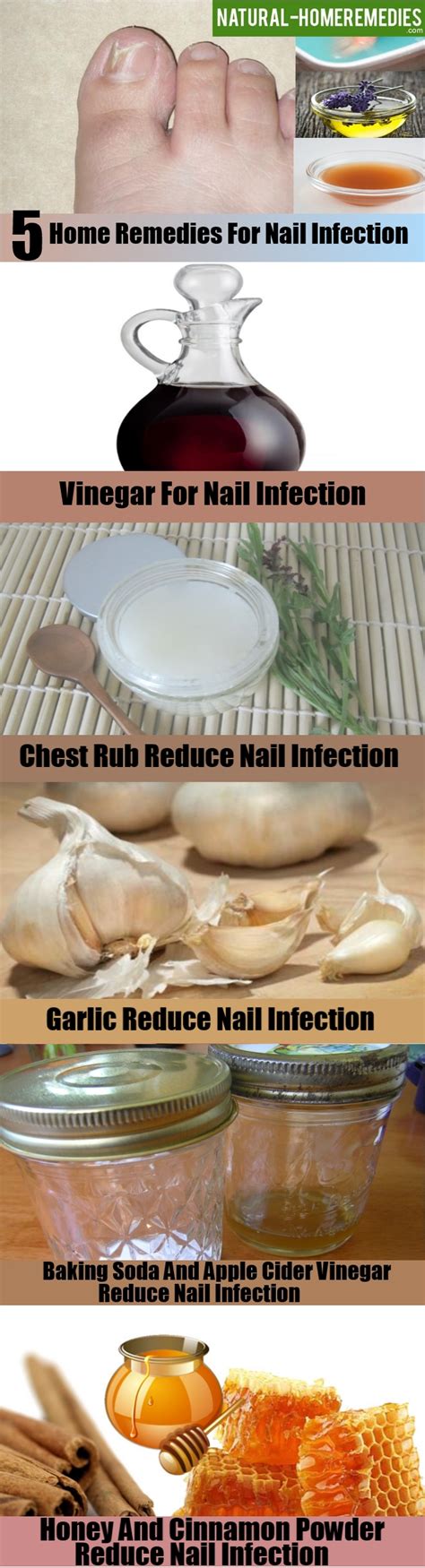 Top 5 Home Remedies For Nail Infection - Natural Treatments For Nail ...