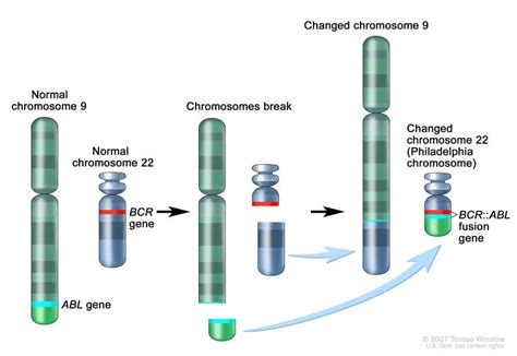 Chronic Myelogenous Leukemia Treatment - NCI