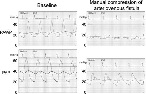 Pulmonary artery wedge pressure (PAWP) and pulmonary artery pressure ...