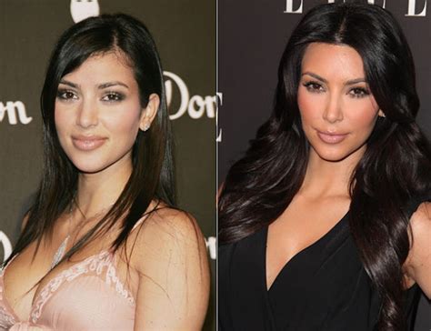 Kim Kardashian Before and After Surgery ~ Styles & Trends