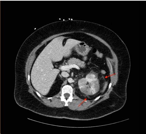 Acute Pyelonephritis with Perinephric Stranding on CT - JETem