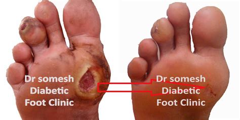 Diabetes Foot Gangrene stages 1st Metatarsal head region - Podiatry Doctor