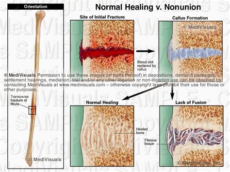 Complications Associated with Fracture Injuries - Medivisuals Inc.