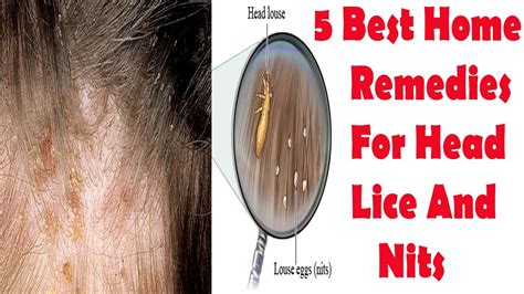 Head Lice Natural Treatment - 5 Best Home Remedies For Head Lice And Nits - YouTube