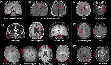 Epilepsy Brain Damage