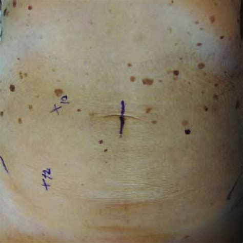 Hand-port incision and port positions for sigmoid colectomy and... | Download Scientific Diagram