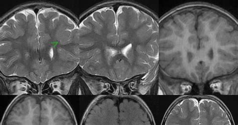 Dr Balaji Anvekar FRCR: Focal Cortical Dysplasia MRI