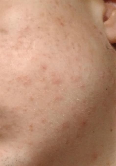 [Acne] Red dots on face that's not pimples? : r/SkincareAddiction