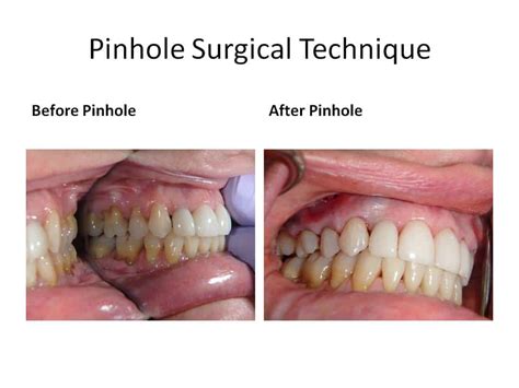 Pinhole Surgery Technique - Gum Recession & PST | Geneva IL Dentist