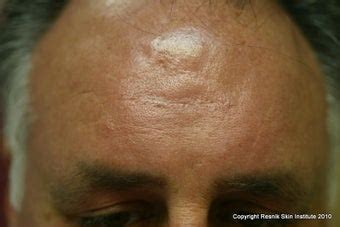 Forehead scar revision with simple excision photo from Barry Resnik, MD ...