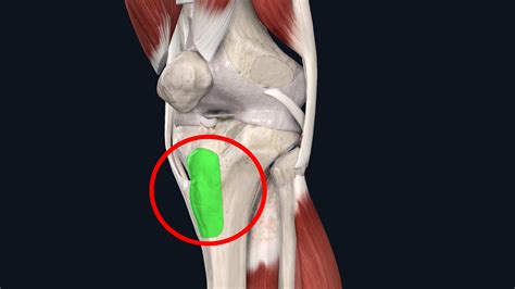 Osgood-Schlatter Disease: Causes, Symptoms, And Treatment | Airrosti