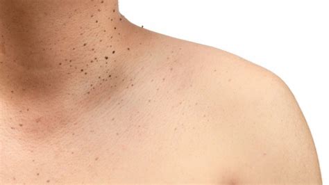 Skin Tag Treatment & Removal - Toronto Dermatology Centre