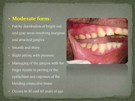 Desquamative Gingivitis