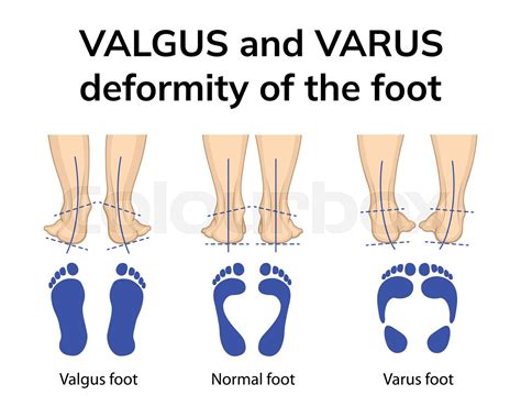 Varus and valgus deformity of the foot | Stock vector | Colourbox