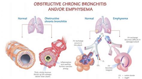 17 Best images about COPD (Chronic Obstructive Pulmonary Disease) on Pinterest | Respiratory ...