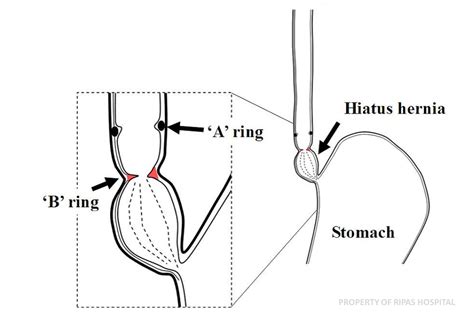 Schatzki Ring Treatment & Management