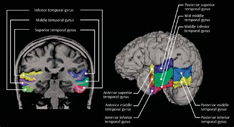 Figure 1 from Middle and Inferior Temporal Gyrus Gray Matter | Semantic ...