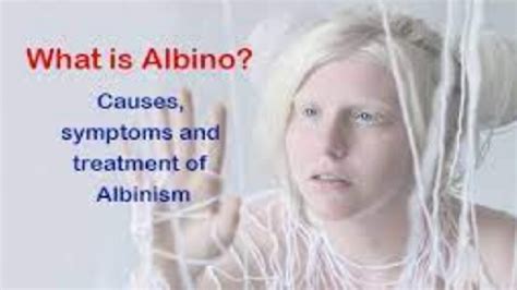 What Is Albinism - Symptoms, Causes, And Diagnosis (VIDEO)