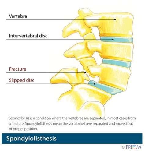 Spondylolysis Vs Spondylolisthesis