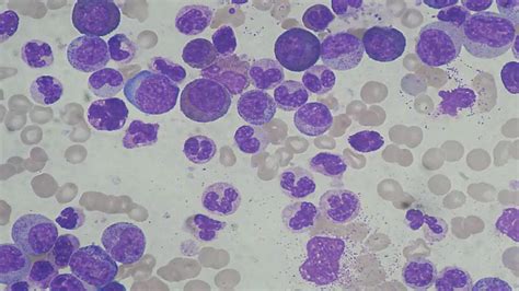 Leukocytosis: Types, Causes, Symptoms, Complications & Treatment