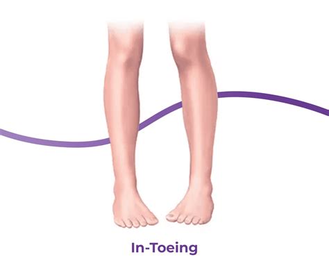 In-Toeing & Out-Toeing: Causes, Symptoms & Treatment | The Feet People ...