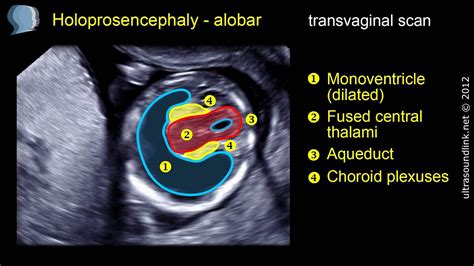 Holoprosencephaly (alobar) - YouTube