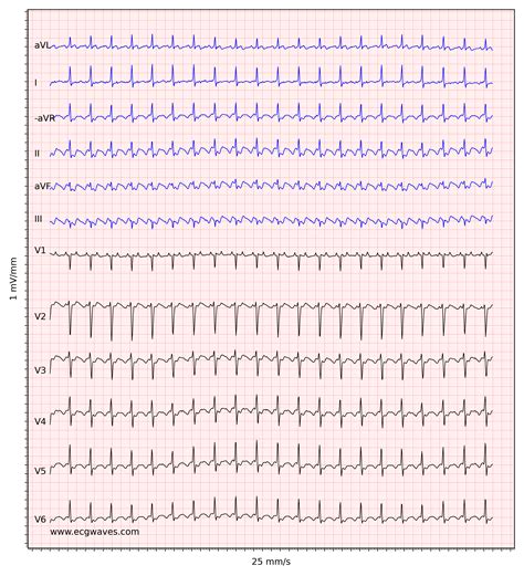 Atrial flutter: classification, causes, ECG diagnosis & management – ECG & ECHO