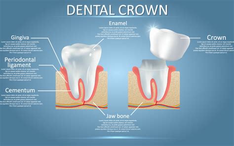 5 Benefits of a Dental Crown