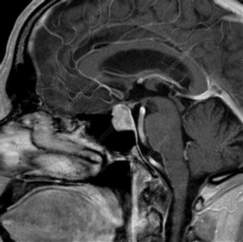 Pituitary macroadenoma, MRI - Stock Image - C039/3570 - Science Photo ...