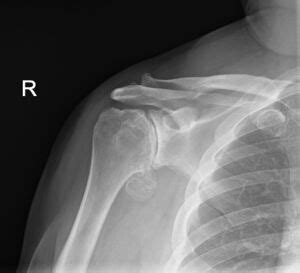 Shoulder Osteoarthritis - Physiopedia