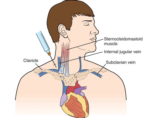 Subclavian Vein—Central Venous Access | Anesthesia Key