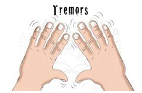 Benign Essential Tremor (Tremor )