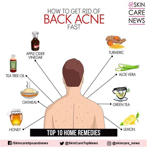 How to Get Rid of Back Acne Fast - Skin Care Top News