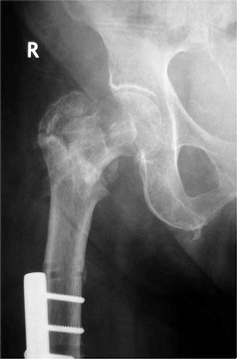 Complications. Re-fracture occurred after external fixator removal in ...