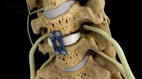 Spine Fusion Surgery - Expert Chikitsa