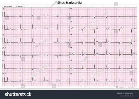 Ecg Sinus Bradycardia 12 Lead Ecg Stock Vector (Royalty Free ...