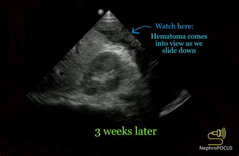 Retroperitoneal hematoma – NephroPOCUS