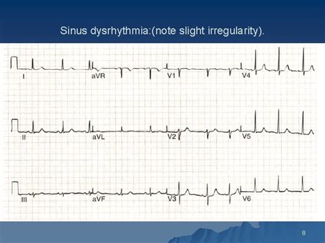 1 Conduction Disturbances 2 SINUS BRADYCARDIA SINUS TACHYCARDIA