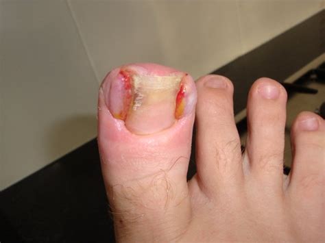 Ingrown Toenails. – Eltham Foot Clinic: your foot doctors