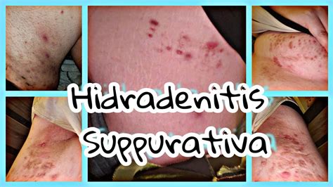 My Hidradenitis Suppurativa - YouTube