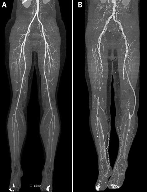 Lower Extremity Arterial Anatomy Ultrasound