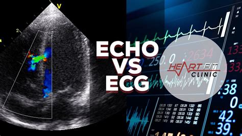 Echocardiogram vs Electrocardiogram - YouTube