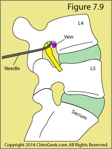 epidural steroid & sciatica education from a world-renowned spine expert