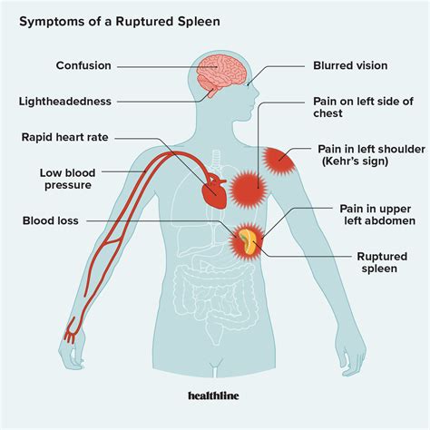 Symptoms of a Ruptured Spleen and When to Seek Help