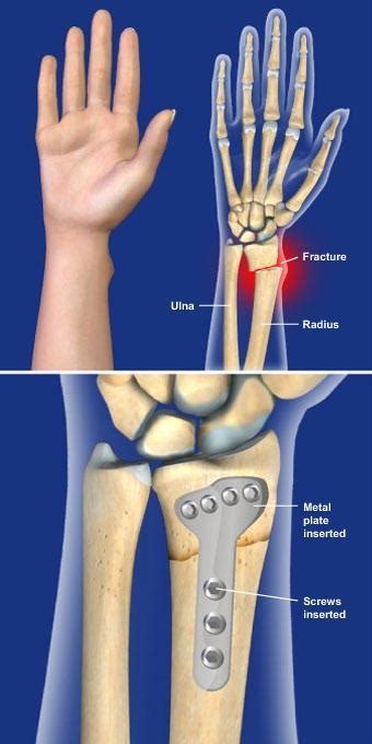 Distal Radius Fracture Repair with Volar Plate - Sarasota, FL ...