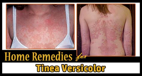 Home Remedies for Tinea Versicolor - Remedies Lore