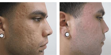 Fractional co2 Laser Before After | Skin Resurfacing