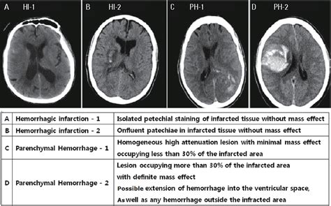 Figure 4 from Magnetic Resonance Imaging in Acute Ischemic Stroke Treatment | Semantic Scholar